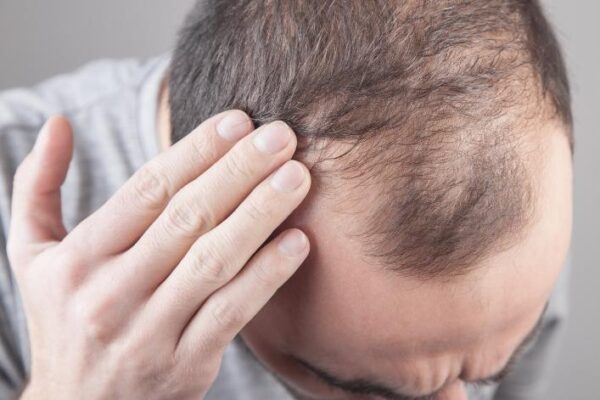 hair thinning