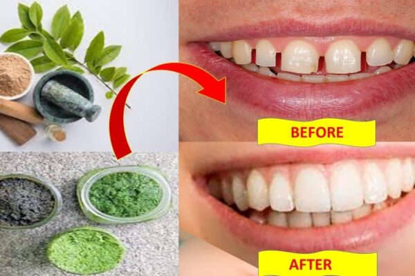 How to Reduce Gap Between Teeth Naturally at Home