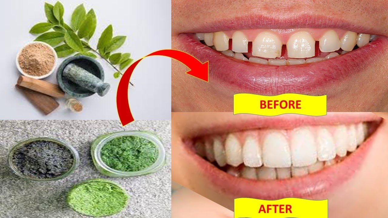 How to Reduce Gap Between Teeth Naturally at Home