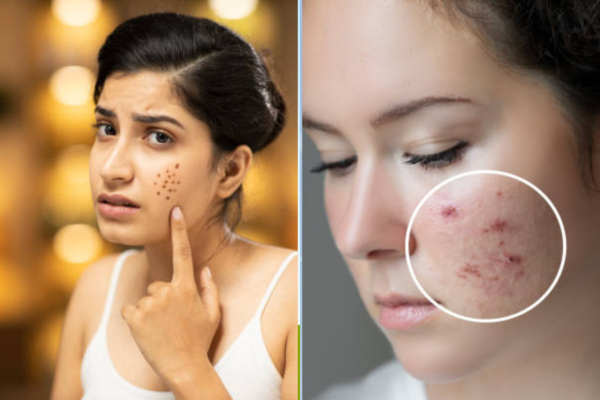How to Remove Acne Scars Naturally in a Week