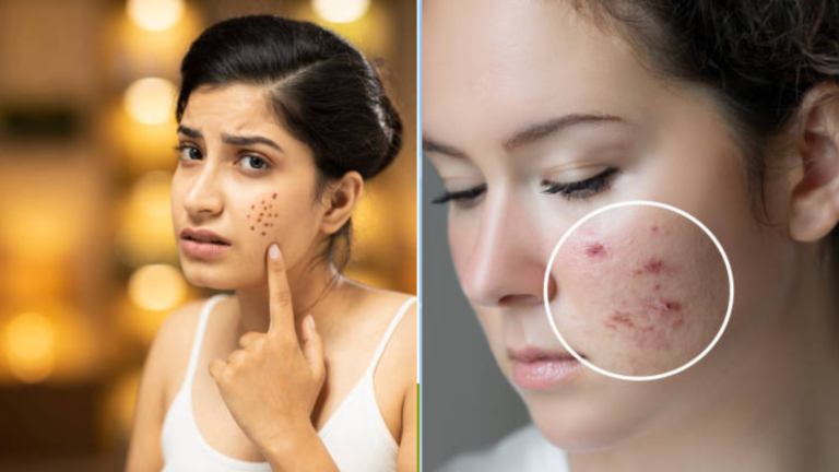 How to Remove Acne Scars Naturally in a Week