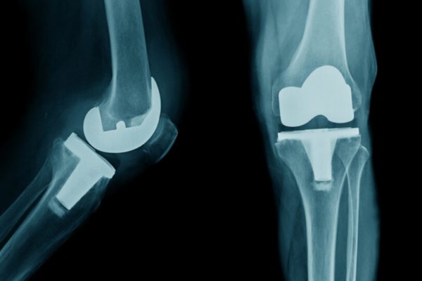 Knee Pain While Climbing Stairs: Causes and Treatment Options