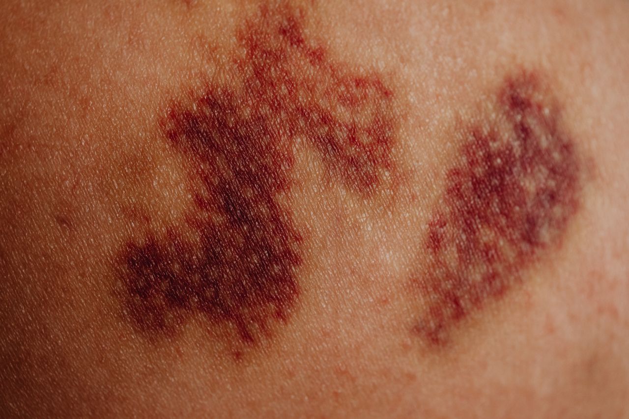 Actinically Damaged Skin: Causes, Signs, Treatment, and Prevention